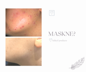 Maskne Treatment